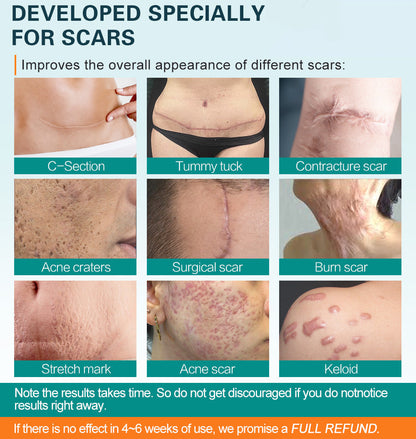 Advanced Scar Spray For All Types of Scars - For example Acne Scars, Surgical Scars and Stretch Marks