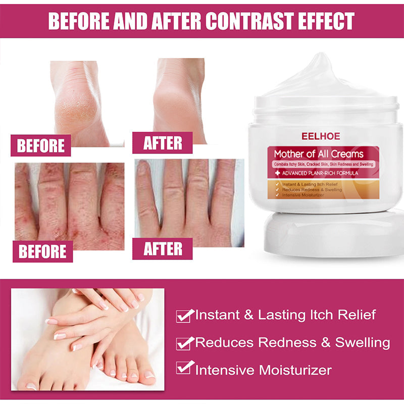 EELHOE™ Multi- Symptom Psoriasis Treatment Cream