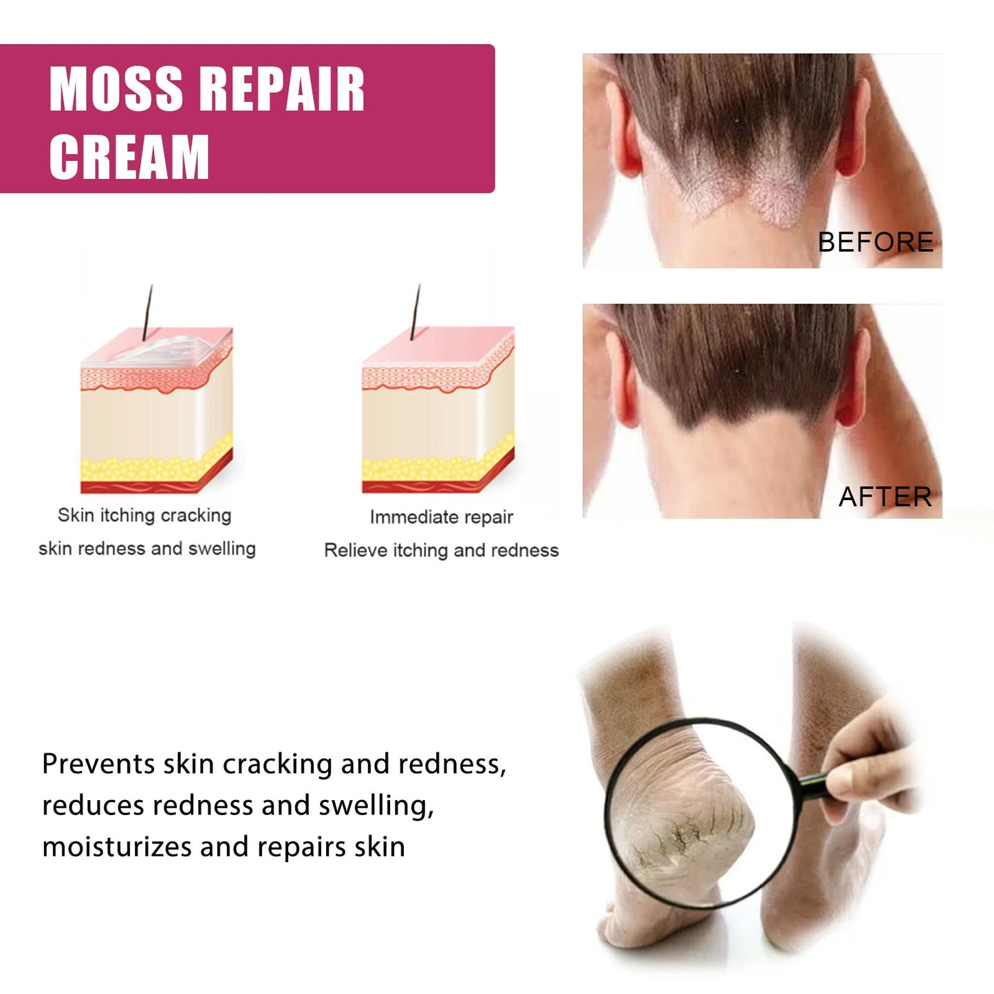 EELHOE™ Multi- Symptom Psoriasis Treatment Cream