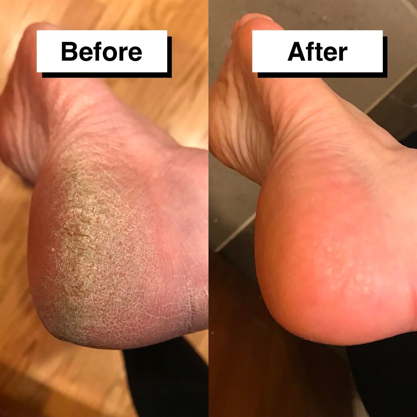 Automatic Callus Remover