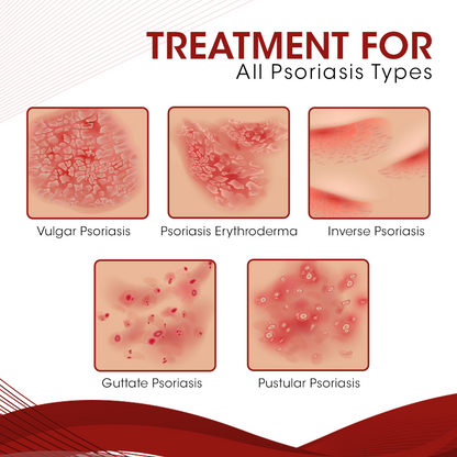 Sprae Cóireála Díolacháin-Psoriasis Hot