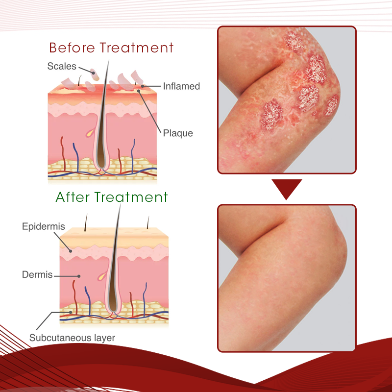 Sprae Cóireála Díolacháin-Psoriasis Hot