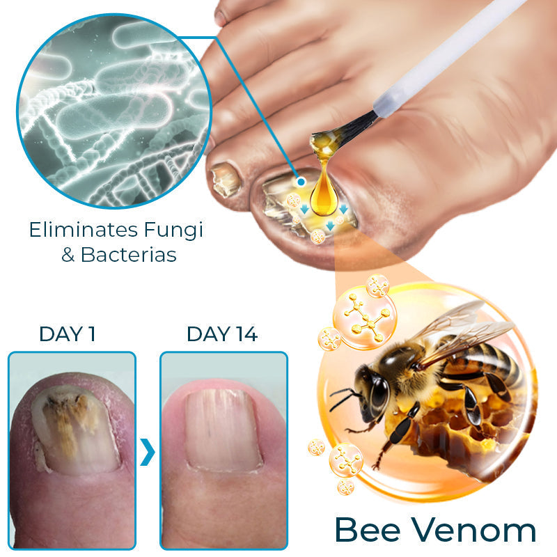 Bee Venom Nail Fungus Treatment Solution