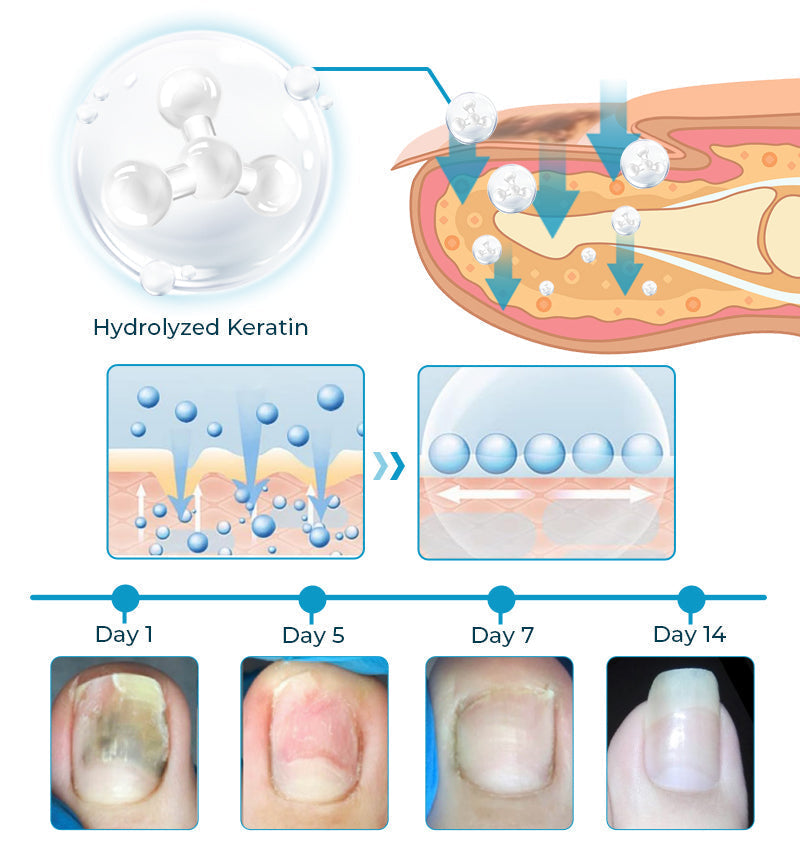 Bee Venom Nail Fungus Treatment Solution