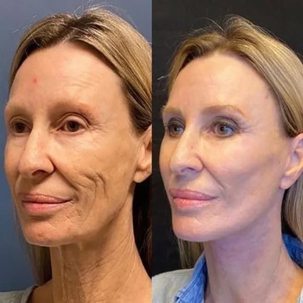 Ορός προσώπου Botox